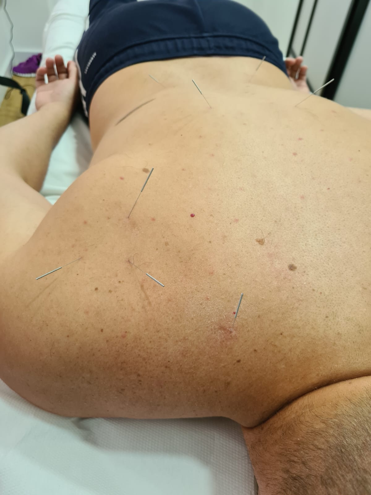 dry-needling